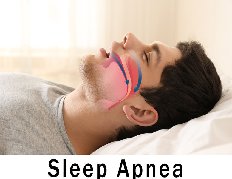 OSAS Obstructive Sleep Apnea Syndrome